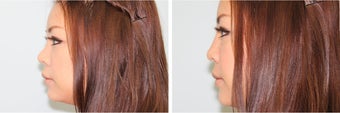 Nasal filler