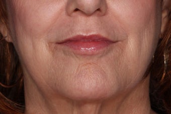 Juvederm Lip Enhancement