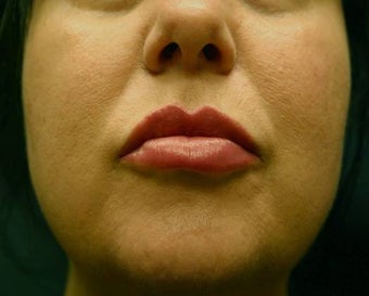 Juvederm Lip Augmentation