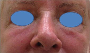 Juvederm Filler for lower eyelid hollows
