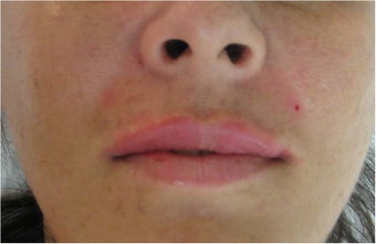 Juvederm for upper lip and nasolabial folds