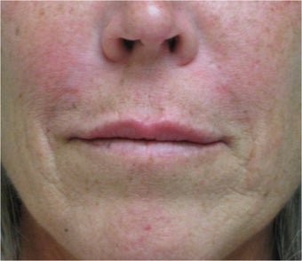 Juvederm to the upper lip