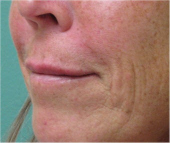 Juvederm to Upper Lip