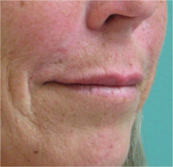 Juvederm to the upper lip