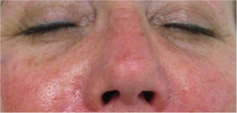 Juvederm for lower eyelid hollows