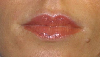Juvederm Lip Augmentation