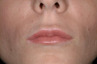 Juvederm Ultra