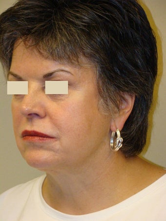 Juvederm Injections for midface