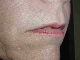 Juvederm to upper lip