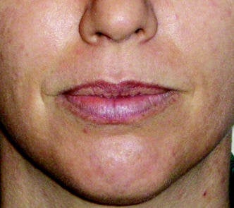 Lip Augmentation with Juvederm