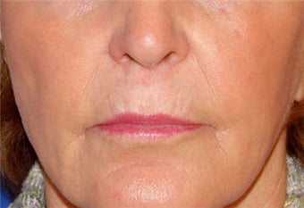 Juvederm for Lip Border and Lip Lines
