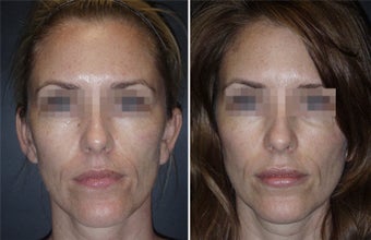 Juvederm