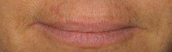 Juvederm to Lips