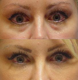 Juvederm injection in the tear troughs