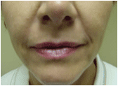 juvederm