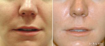Juvederm