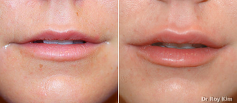 Juvederm