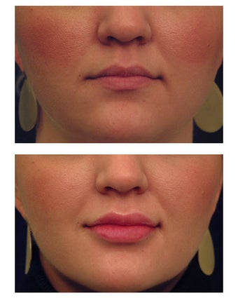 Juvederm