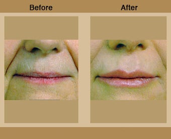 Lip Augmentation
