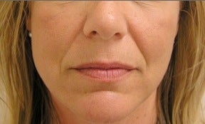 Juvederm