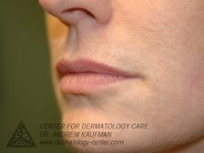 Juvederm Injection to Augment Lip Line