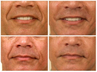 Juvederm