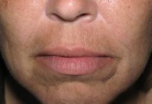 Juvederm
