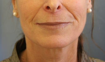 Juvederm injection