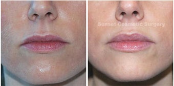 Juvederm: Subtle Lip Enhancement