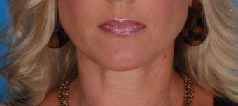 Lip Augmentation with Juvederm