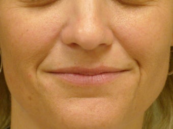 Treatment of prominent nasolabial folds with dermal filler