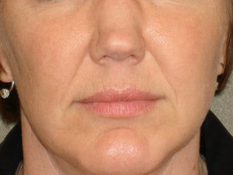 Treatment of prominent nasolabial folds with a dermal filler