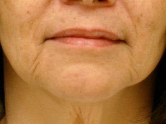 Treatment of marionette lines with a dermal filler
