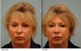 Juvederm