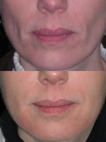 HA filler to the lower face