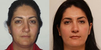 Facial Rejuvenation, non-surgical
