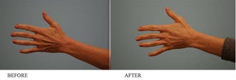 Juvederm to hands
