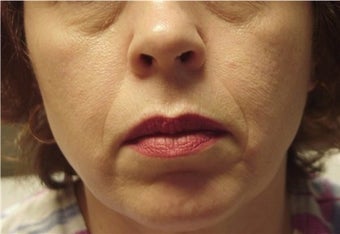 Juvederm