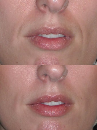 Filler to nasolabial folds