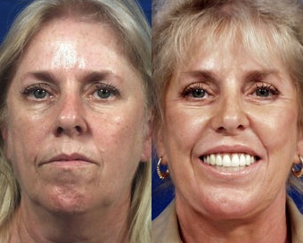 Juvederm
