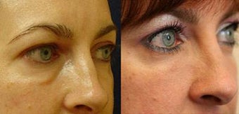 Juvederm Ultra
