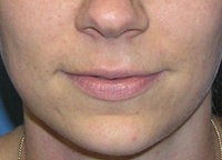 Juvederm Lip Enhancement