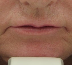 63 year old lip Augmentation with Juvederm
