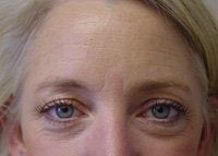 Juvederm & Botox
