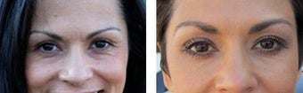 Botox & Juvederm