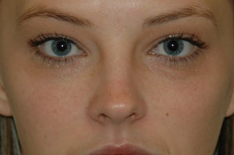 Juvederm injected under the eyes