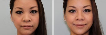 Nasal filler
