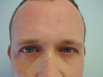 Undereye Filler