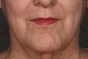 Juvederm Lip Enhancement