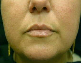 Juvederm Lip Augmentation